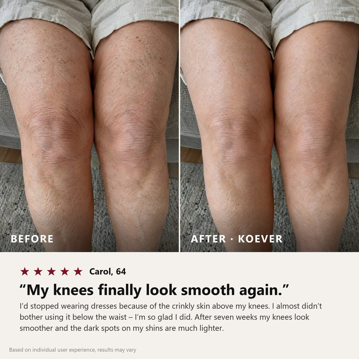 KOEVER Retinal Body Serum – avant apres jambes